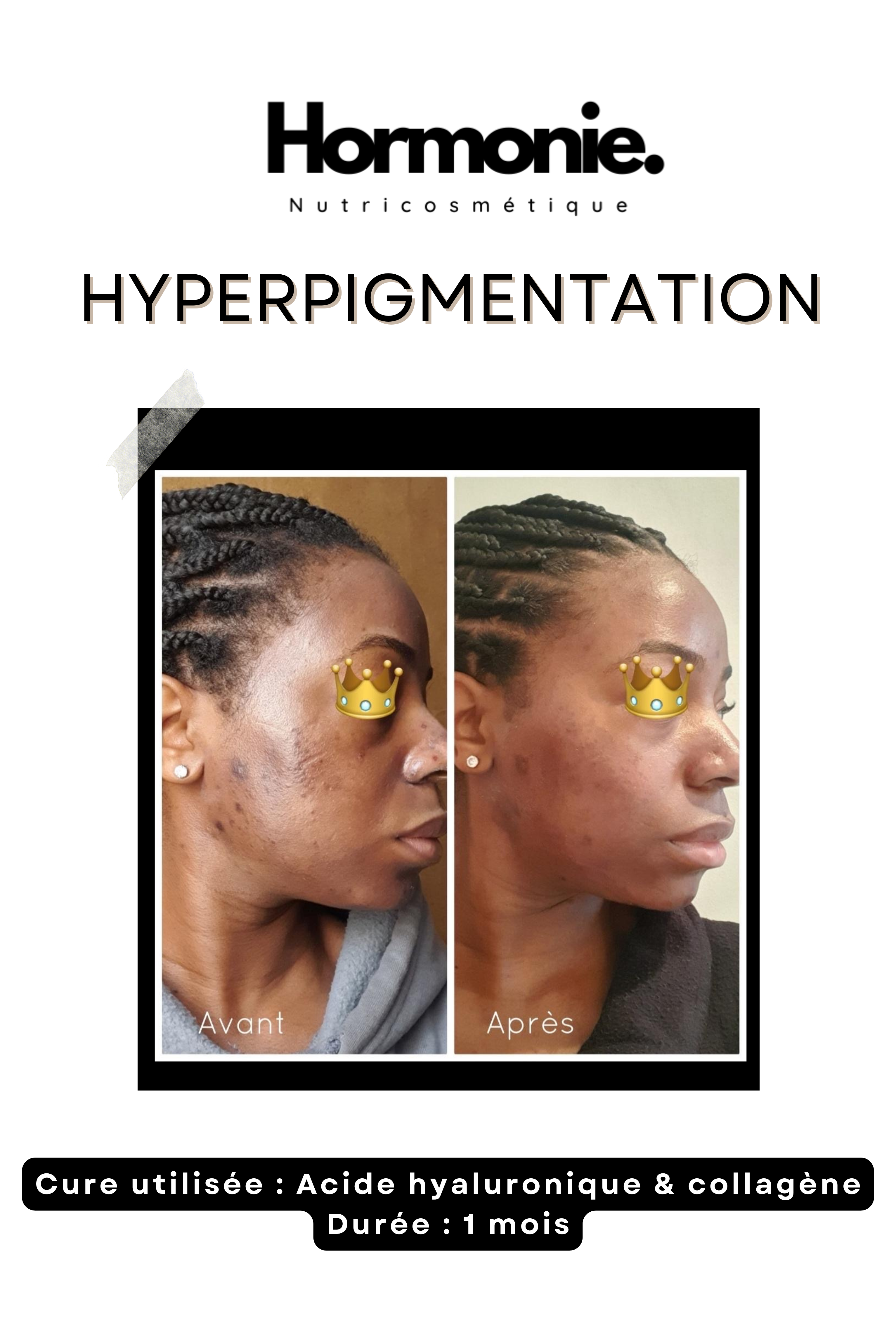 Acide hyaluronique & collagène